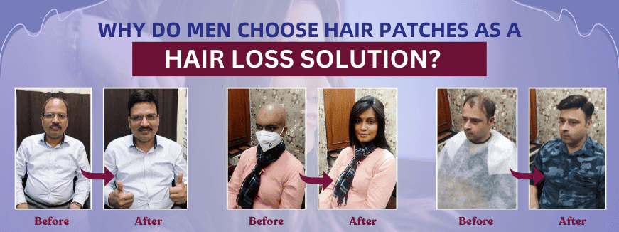 non-surgical-hair-solutions-delhi